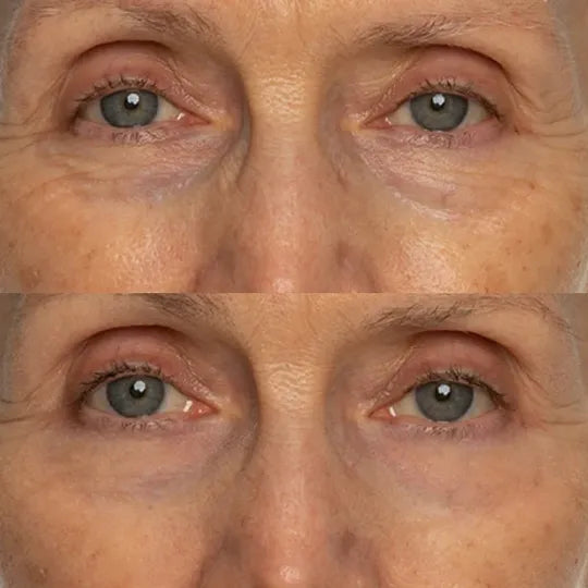 Antes e depois - Linhas dos olhos