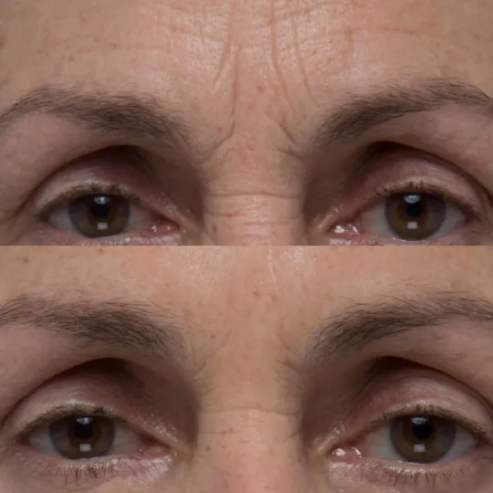 Antes e depois - Código de barras na testa